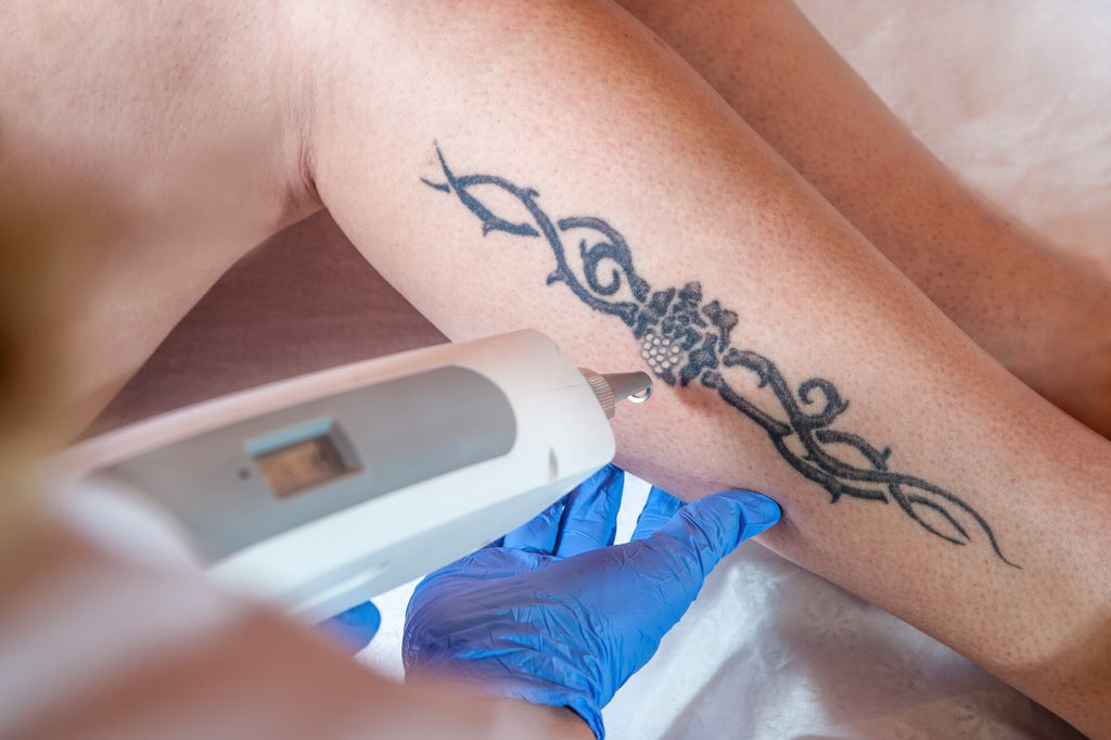 How Exactly Does Laser Tattoo Removal Work?